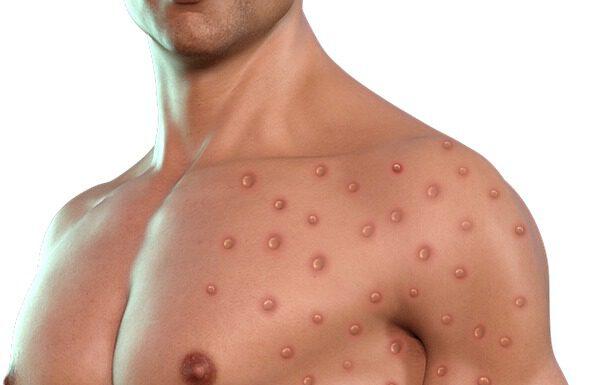 Erster Fall von Affenpocken in der Region Hannover nachgewiesen – Verdachtsfall bestätigt sich, Gesundheitsamt nimmt Kontaktnachverfolgung auf